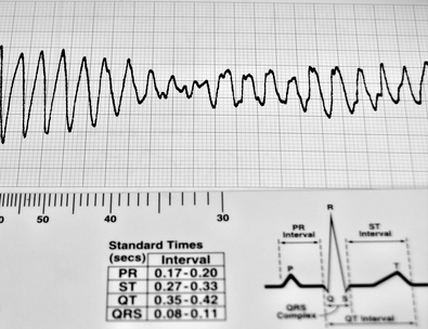 heart attack symptoms pictures. Early Signs of Heart Attack