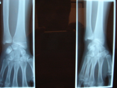 Bones+cancer