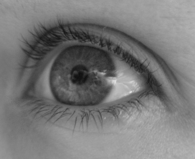 sty in eye. Eye Sty Cures