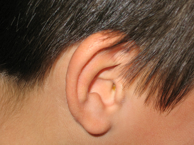 Compacted Ear Wax 14