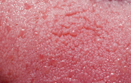  and bottom of the tongue are normally inflamed taste buds, or papillae.