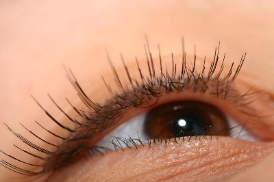 Cholesterol+deposits+around+eyes+pictures