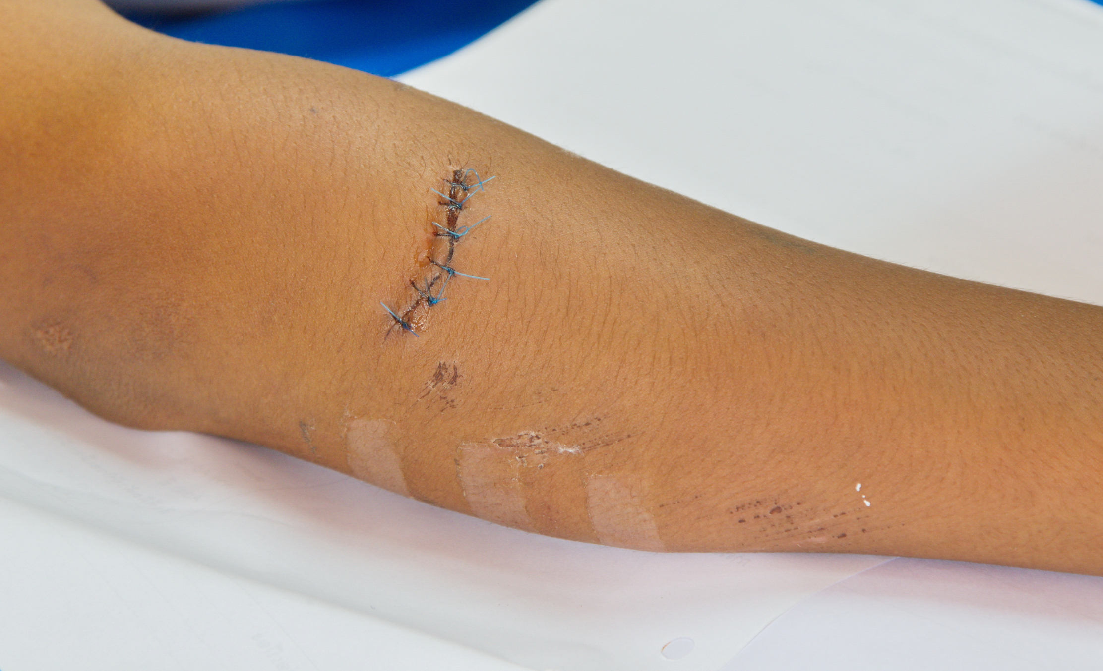 What Makes Scars Go Away Healthfully