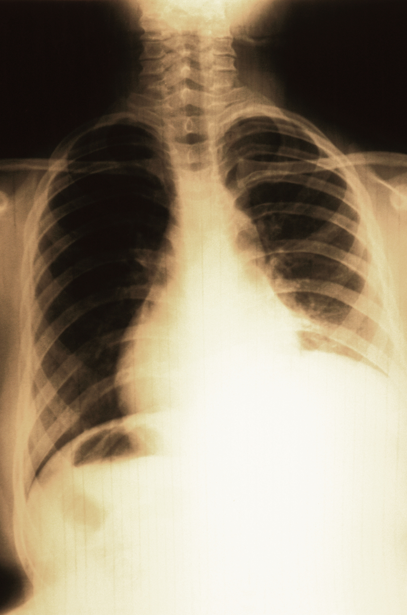 Hyperinflation Chest X Ray