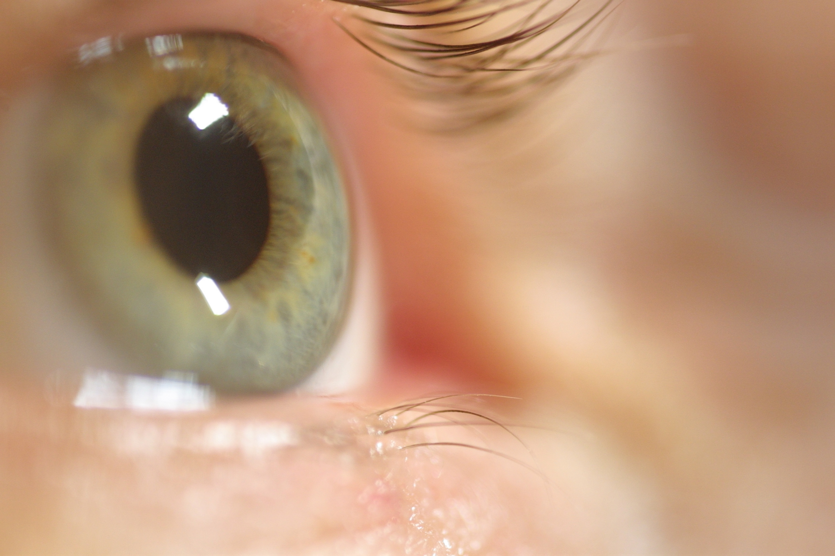 How to Dissolve Cataracts Healthfully