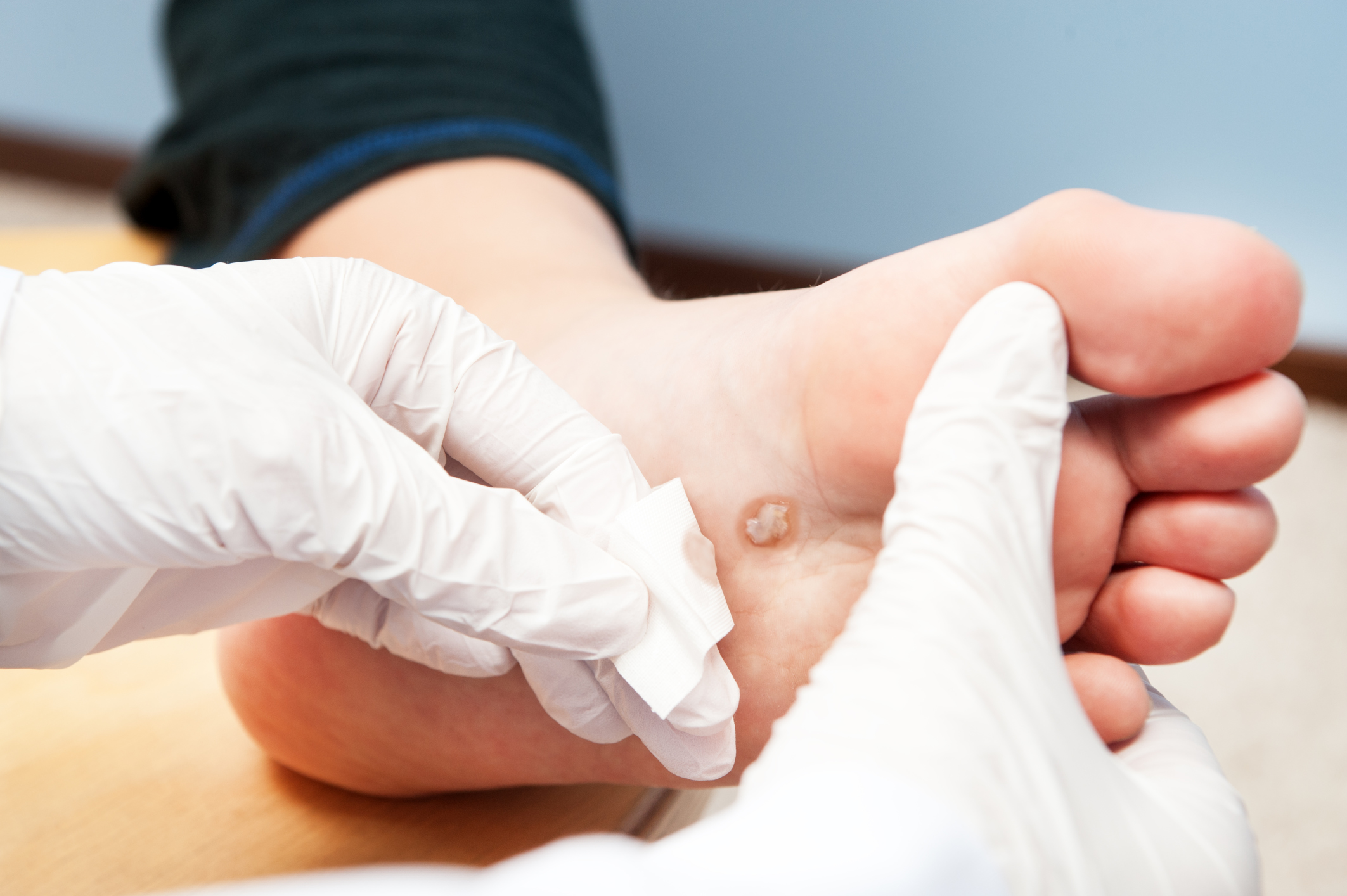What will happen if you tear off the papilloma: medical practice What will happen if you tear off the papilloma: medical practice