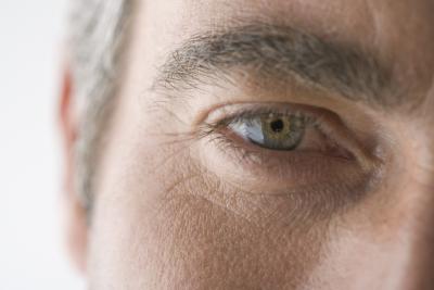 Cholesterol+deposits+under+eyes