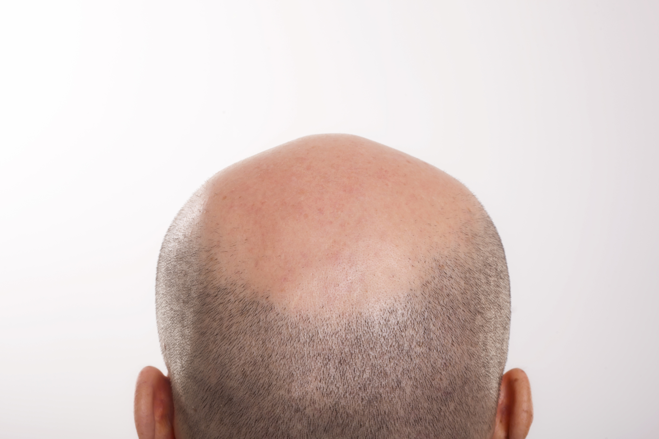 Symptoms Of An Infected Ingrown Hair