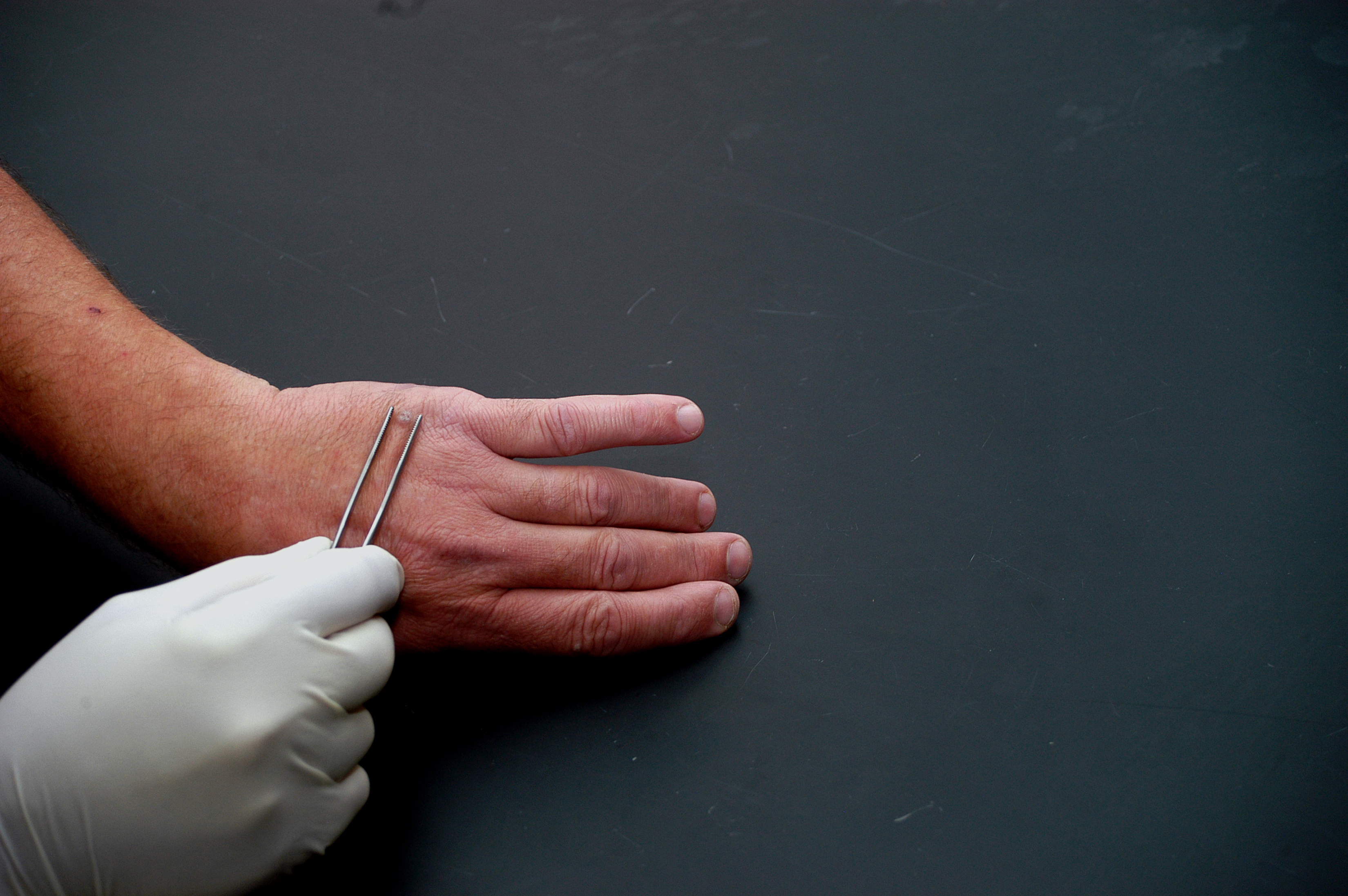 Vulgar warts on the hands, finger, face or foot - photo, treatment Vulgar warts on the hands, finger, face or foot - photo, treatment