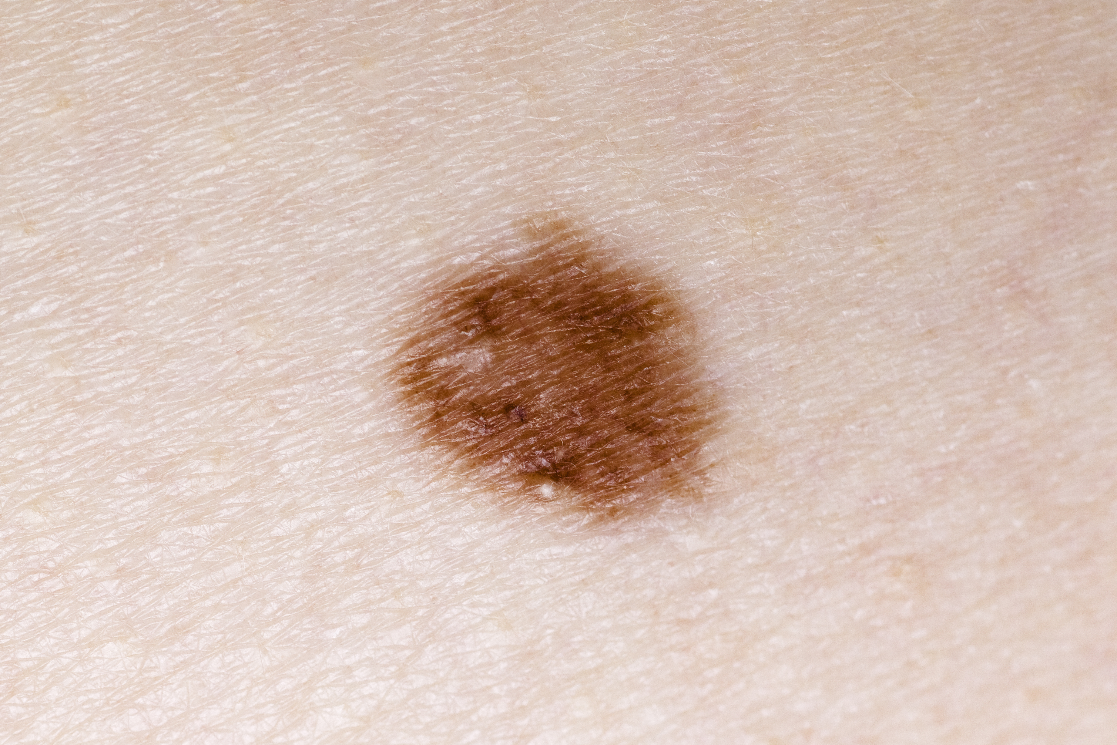 Acne Under A Mole