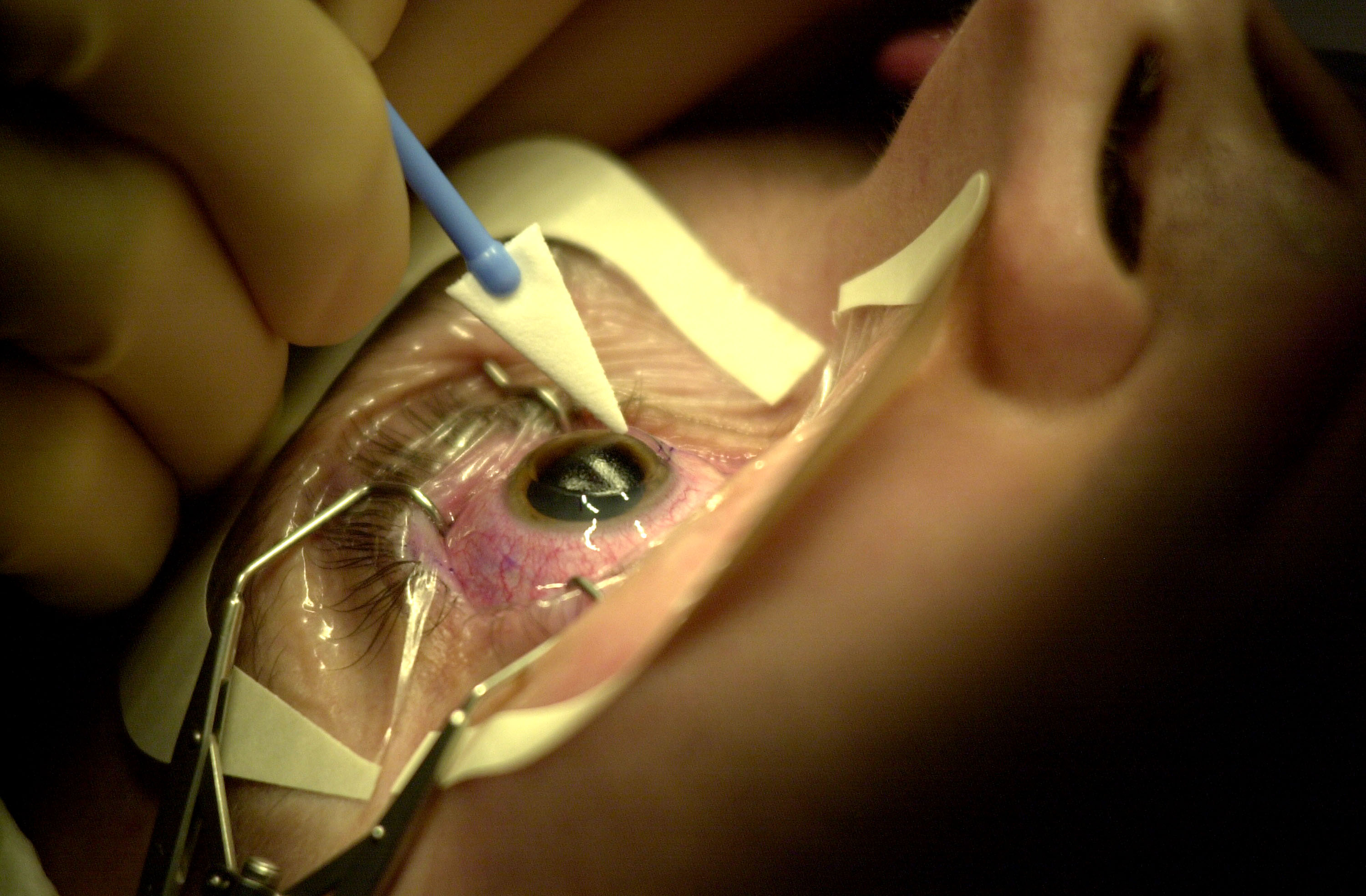 what-is-the-salary-of-a-retinal-eye-surgeon