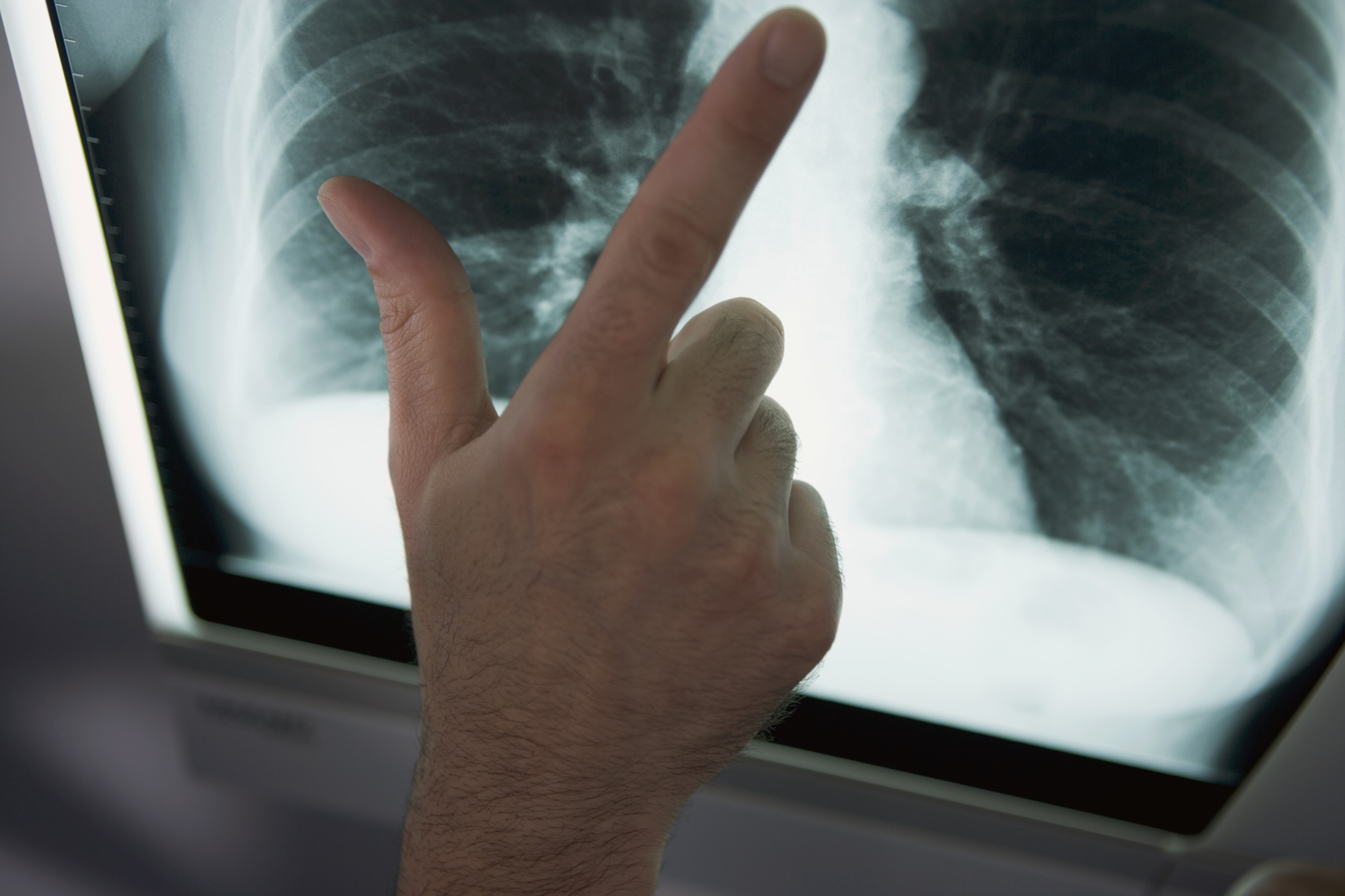 the-dangers-of-tuberculosis-healthfully