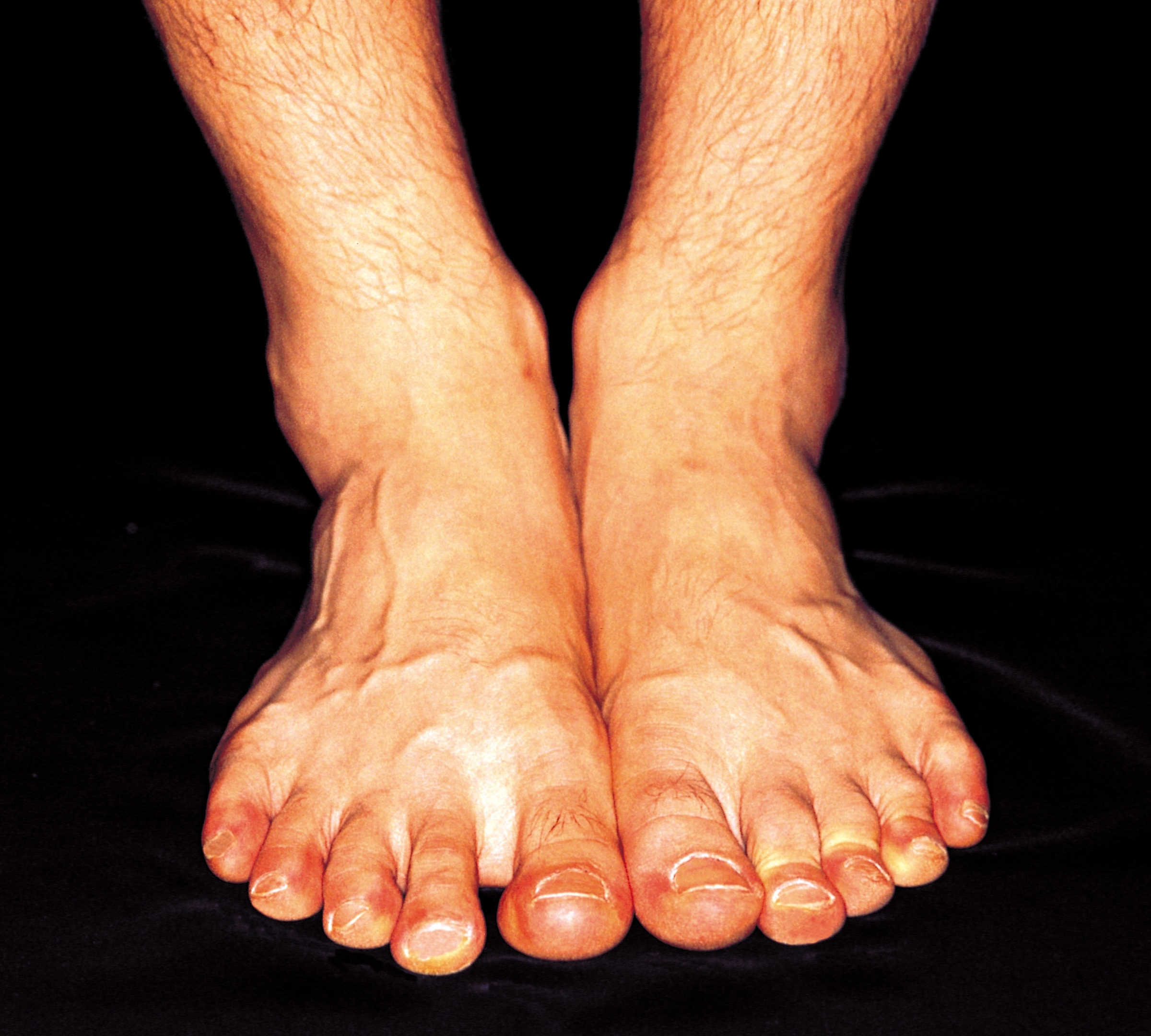 What Causes Red Skin On Feet Ankles Healthfully