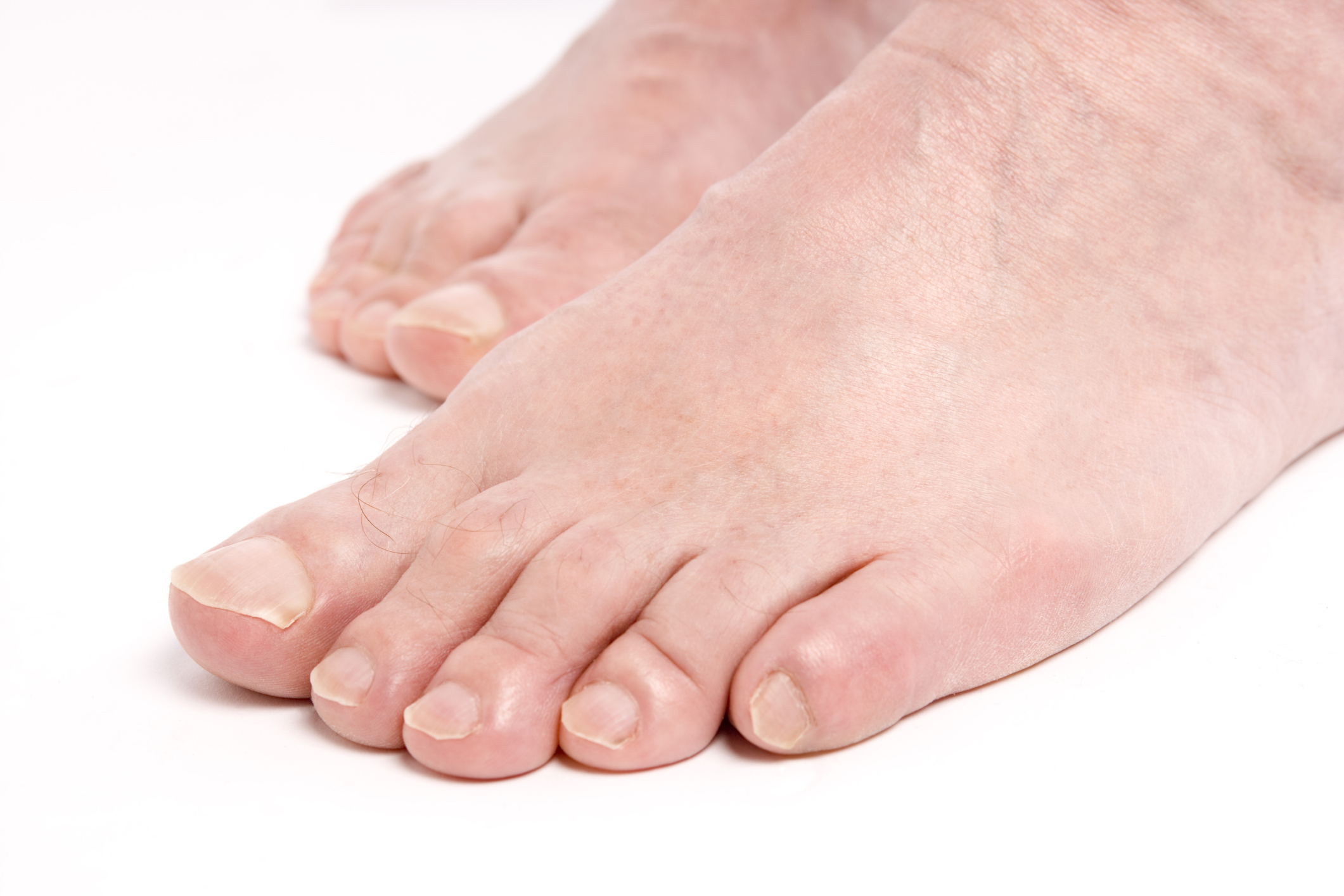 will-clorox-kill-toenail-fungus-healthfully